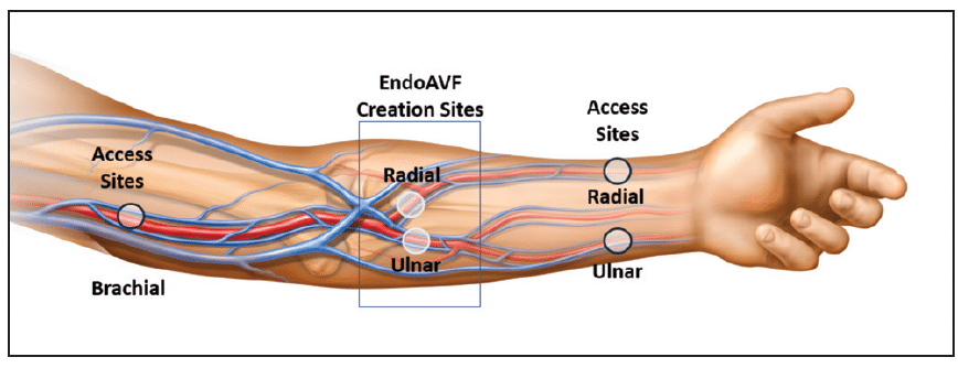 AV Fistula