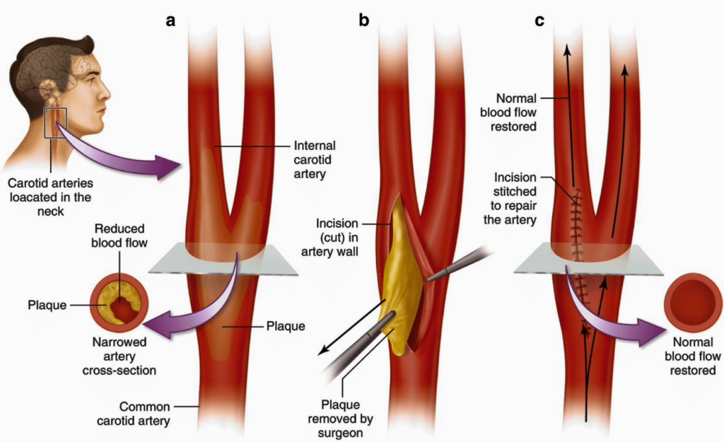 carotid artery